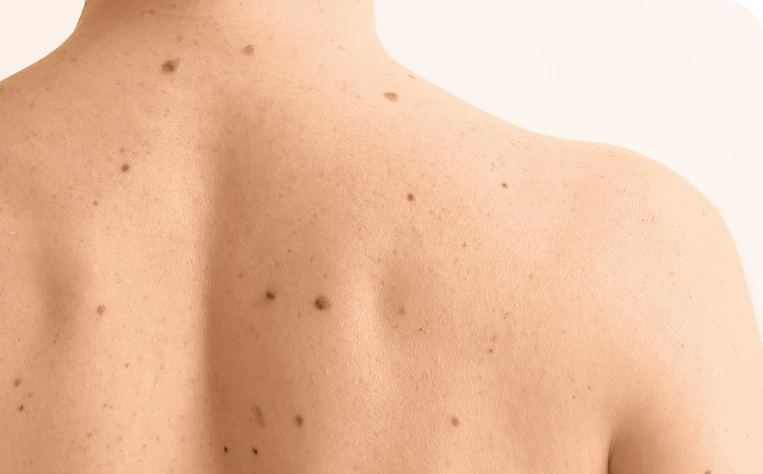 mole_check