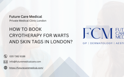 How to Book Cryotherapy for Warts and Skin Tags in London?