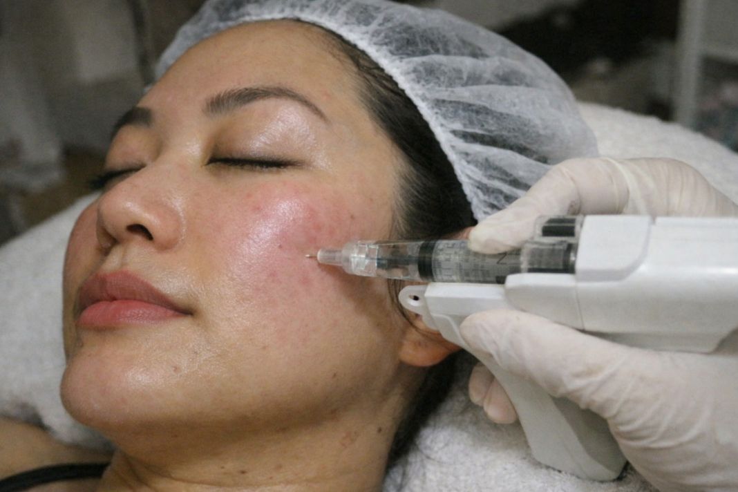 illustrative photo of a person getting mesotherapy treatment illustrative photo of a person getting mesotherapy treatment