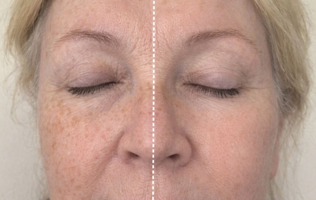 Mesotherapy or Anti-Wrinkle Injections? 5 Signs You’re Choosing the Right One