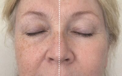 Mesotherapy or Anti-Wrinkle Injections? 5 Signs You’re Choosing the Right One