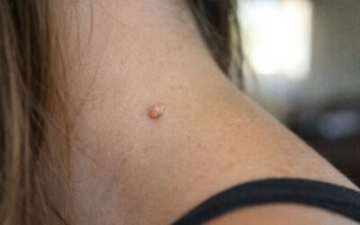 Is Cryotherapy Right for You? Comparing Warts, Skin Tags, and Age Spot Treatments