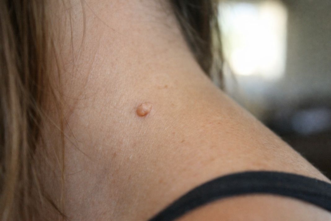 a photo of a small raised skin tag on a person’s neck or arm shown clearly in soft daylight