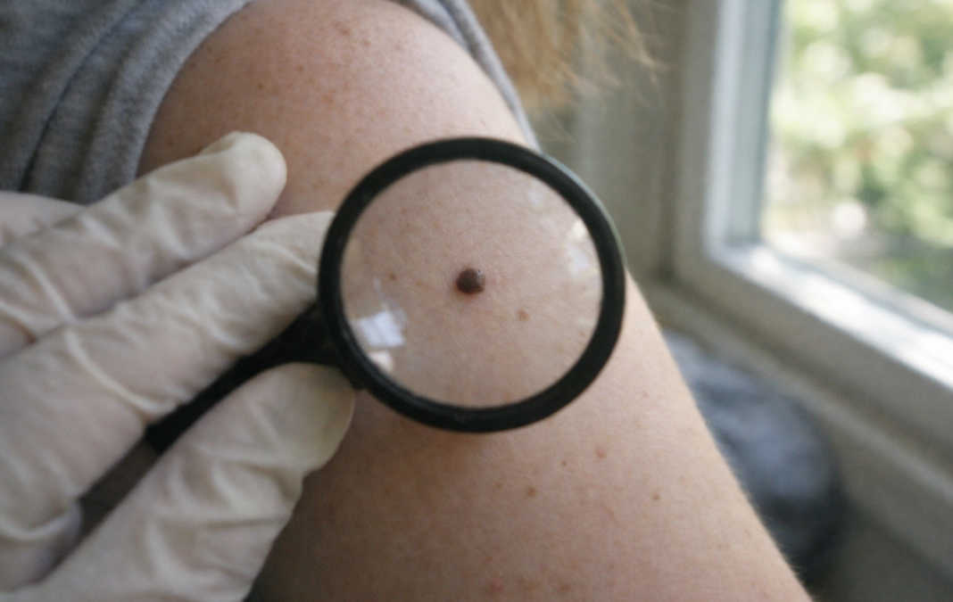 The 5 Subtle Signs You Might Need a Mole Check