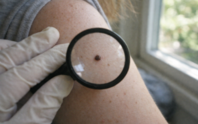 The 5 Subtle Signs You Might Need a Mole Check