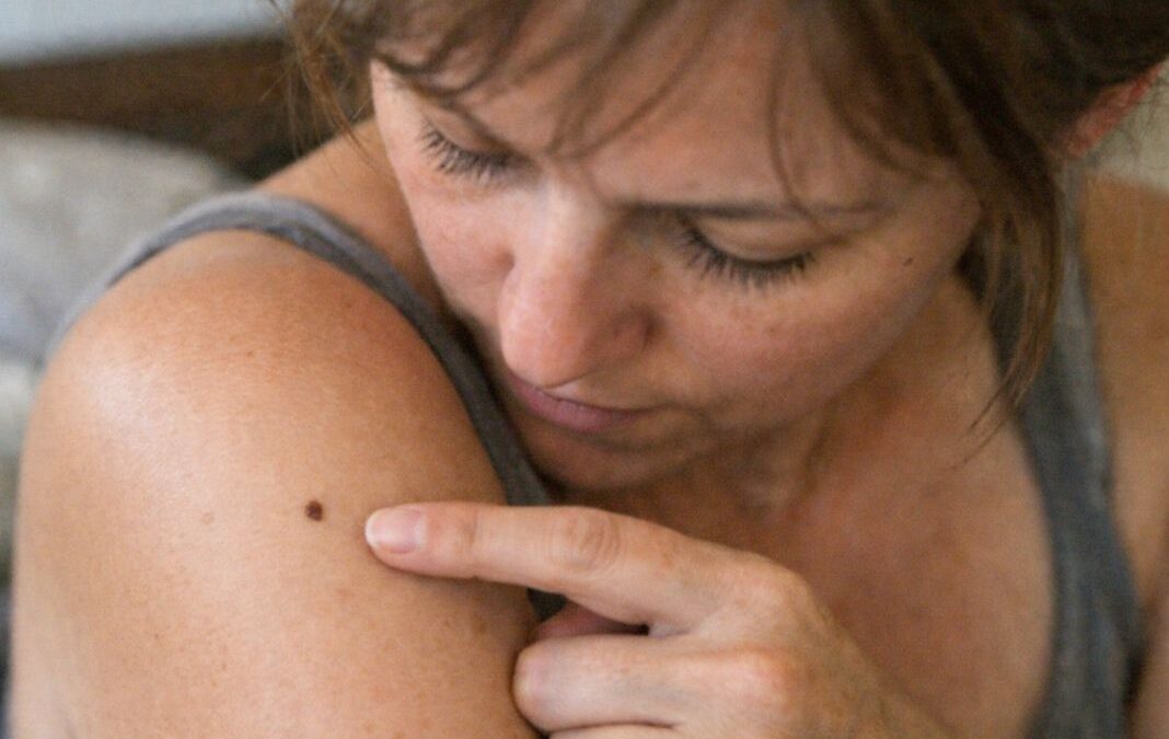 Worried About a Spot? How to Find the Right Dermatologist in London