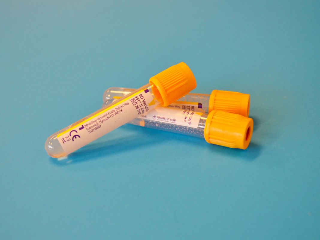 a photo of blood test vials a photo of blood test vials