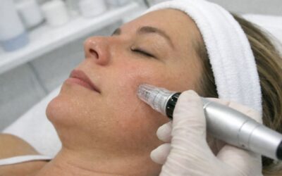 Where to book Sylfirm X RF microneedling in London (what to ask at your consultation)