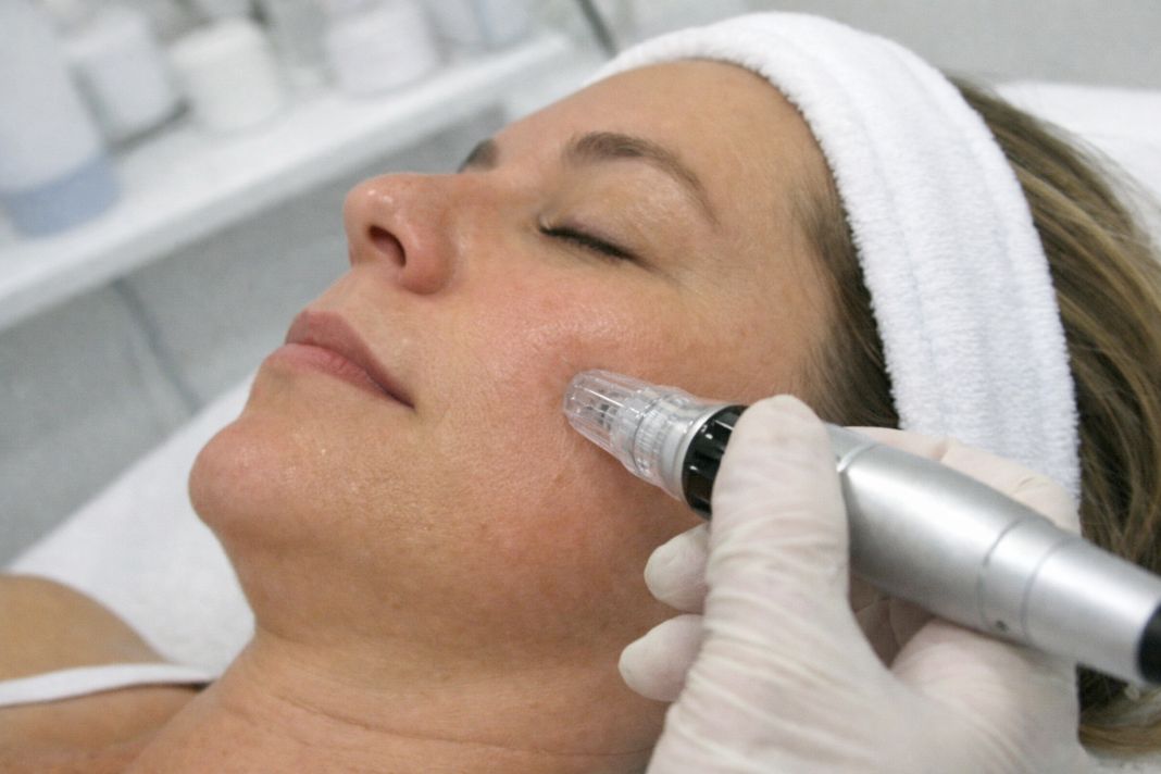 Where to book Sylfirm X RF microneedling in London (what to ask at your consultation)