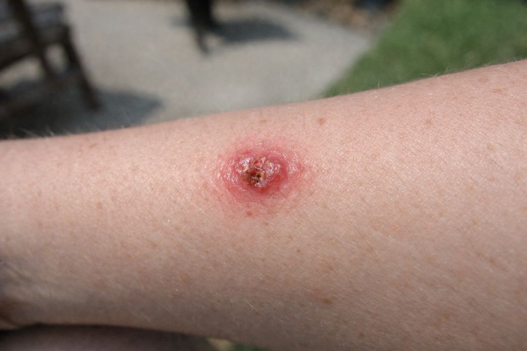 An illustrative photo of a skin lesion