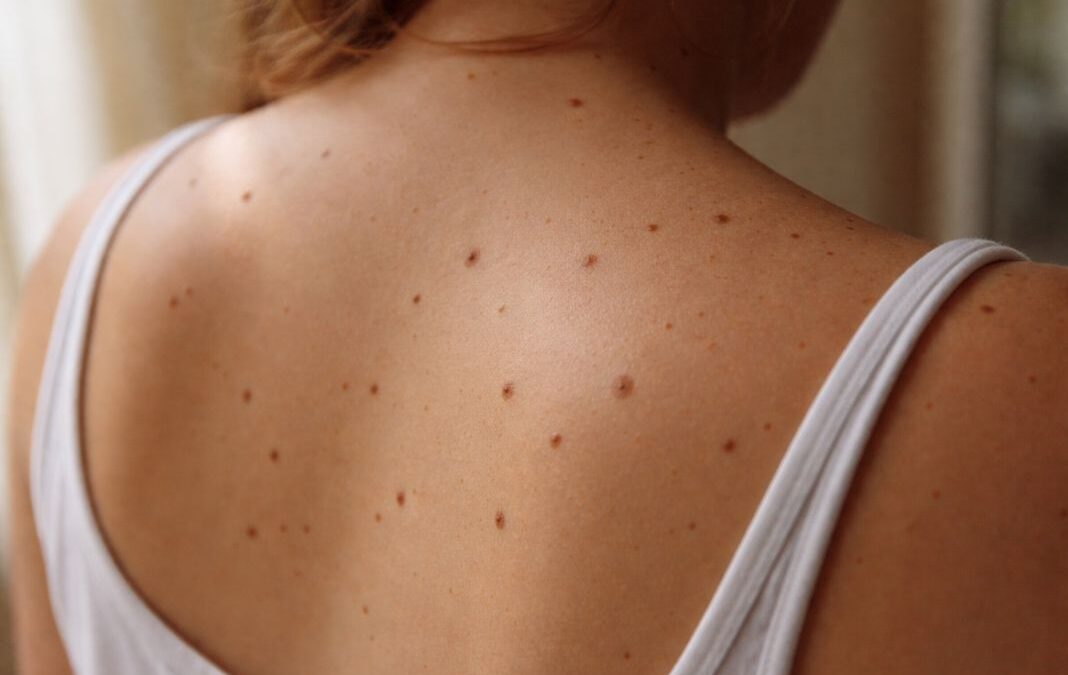 Where to Book a Full-Body Skin Check in London (and How It Differs from a Mole Check)