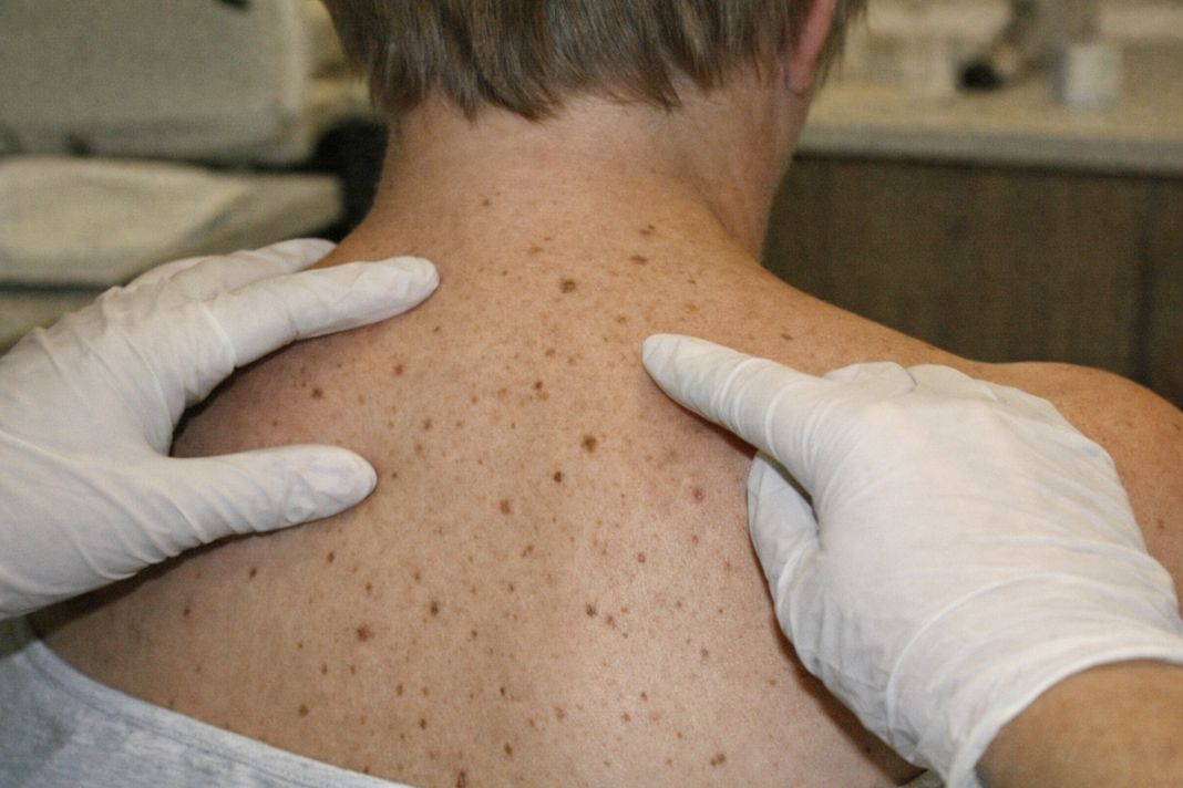 AI photo of a mole check up appointment - Future Care Medical